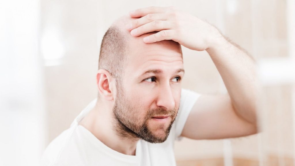 Haarausfall, häufigsten Gründe für Haarausfall und Behandlungsmöglichkeiten