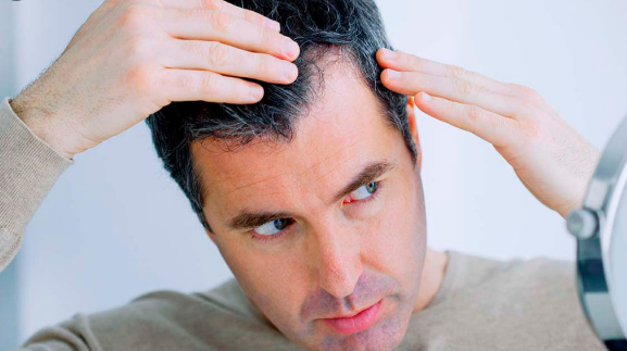 Haarausfall, häufigsten Gründe für Haarausfall und Behandlungsmöglichkeiten